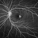 Macular Telangiectasia Type 2 Fluorescein Angiography Macular Telangiectasia Type 2 Fluorescein Angiography