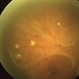 Diabetic Tractional Retinal Detachment Diabetic Tractional Retinal Detachment
