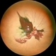 Optic Nerve Avulsion with Vitreous Hemorrhage and Pale Retina Optic Nerve Avulsion with Vitreous Hemorrhage and Pale Retina