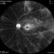 Angiographic Diabetic Macular Edema in a Case of Proliferative Diabetic Retinopathy Angiographic Diabetic Macular Edema in a Case of Proliferative Diabetic Retinopathy