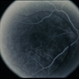 Macular Hole Evolving / Lamellar Hole Macular Hole Evolving / Lamellar Hole