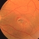 Retinal Hole Retinal Hole