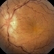 Commotio Retinae