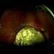 Coloboma involving the Optic nerve, Retina, and Choroid Coloboma involving the Optic nerve, Retina, and Choroid
