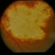 Peculiar Acute Subretinal Fibrosis Peculiar Acute Subretinal Fibrosis