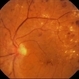 NVD in Proliferative Diabetic Retinopathy