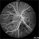 Radiation Retinopathy Radiation Retinopathy