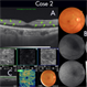 Figure-2 Paracentral Acute Middle Maculopathy (PAMM) Figure-2 Paracentral Acute Middle Maculopathy (PAMM)