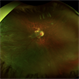 ROP related retinal detachment ROP related retinal detachment