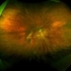 Tilted Disc Syndrome Complicated with RPE Atrophy and Polypoidal Choroidal Vasculopathy Tilted Disc Syndrome Complicated with RPE Atrophy and Polypoidal Choroidal Vasculopathy
