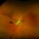 Proliferative Diabetic Retinopathy