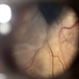 Coats' Related Total Serous Retinal Detachment