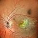 Choroidal Neovascular Membrane