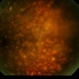 Necrotizing Retinitis Necrotizing Retinitis
