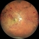 Central vein occlusion (chronic)