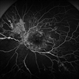 Severe Proliferative Diabetic Retinopathy Severe Proliferative Diabetic Retinopathy