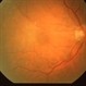 Macular Pucker Complication of  Laser Photocoagulation Macular Pucker Complication of  Laser Photocoagulation