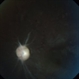 Post Papillitic Optic Atrophy Post Papillitic Optic Atrophy