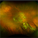 Neovascular Age-Related Macular Degeneration (2) Neovascular Age-Related Macular Degeneration (2)