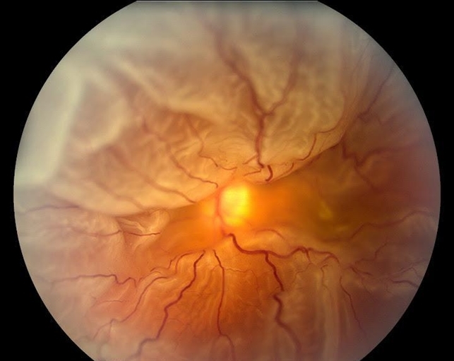 360-degree-retinal-detachment-retina-image-bank