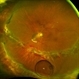 Methotrexate Bubble in Silicone Oil Filled Eye: Proliferative Vitreoretinopathy Prevention Methotrexate Bubble in Silicone Oil Filled Eye: Proliferative Vitreoretinopathy Prevention