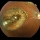 Macular Coloboma