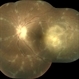 Vasculitis With Choroidal Granuloma Vasculitis With Choroidal Granuloma