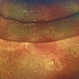 Post Combined Surgery of Cataract, TRD & Vitreous Hemorrhage
