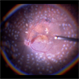 Intra-operative PRP in a diabetic vitrectomy case Intra-operative PRP in a diabetic vitrectomy case