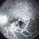 Nonperfused BRVO with Collateral Vessels Nonperfused BRVO with Collateral Vessels