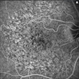 Pentosan Maculopathy Fluorescein Angiogram Right