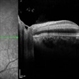 Central Retinal Artery Occlusion
