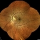 Idiopathic Multifocal Choroiditis Idiopathic Multifocal Choroiditis