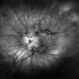 Central Retinal Artery Occlusion Secondary to Endophthalmitis Central Retinal Artery Occlusion Secondary to Endophthalmitis