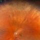 Retinal Tear