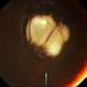Choroidal Coloboma Choroidal Coloboma
