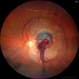 Ruptured Retinal Artery Macroaneurysm Ruptured Retinal Artery Macroaneurysm