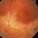 Pseudo Retinitis Pigmentosa Pseudo Retinitis Pigmentosa