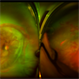 Aggressive Posterior Retinopathy of Prematurity