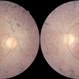 Retinitis Pigmentosa Retinitis Pigmentosa