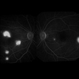 Central Serous Chorioretinopathy Associated With Steroids Central Serous Chorioretinopathy Associated With Steroids
