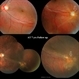 'Untouched' Intra-ocular Foreign Body - Course Over 7 Years! 'Untouched' Intra-ocular Foreign Body - Course Over 7 Years!