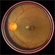 Valsalva-Retinopathy: Smartphone Fundus Image Valsalva-Retinopathy: Smartphone Fundus Image