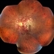 Acute Necrotizing Retinal Vasculitis as Onset of Systemic Lupus Erythematosus. Acute Necrotizing Retinal Vasculitis as Onset of Systemic Lupus Erythematosus.
