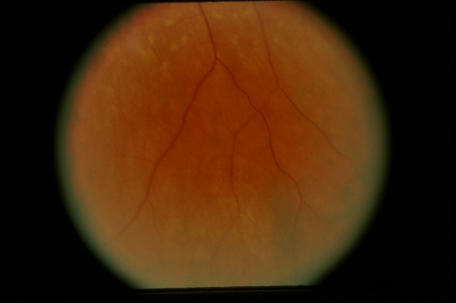 Albipunctatus Variant / Pseudo-S.O. - Retina Image Bank