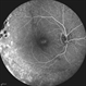 X-Linked Retinoschisis X-Linked Retinoschisis