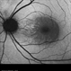 Acquired Optic Pit Maculopathy Acquired Optic Pit Maculopathy