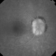 Optic Nerve Edema
