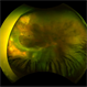 FEVR and Cataract