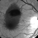 Ruptured Macroaneurysm in a 68-Year-Old Man - Red free image